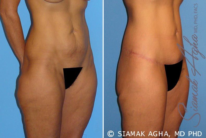 Lower Body Lift Before & After