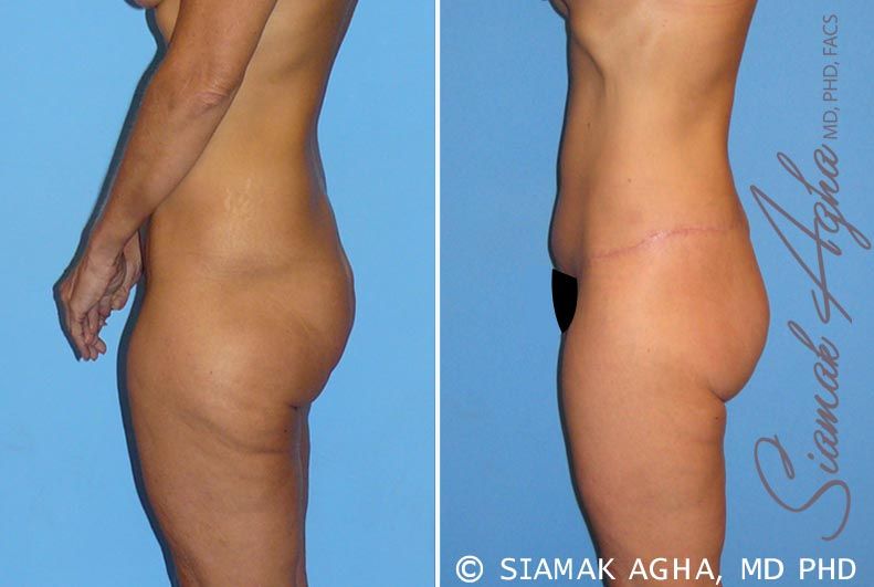 Lower Body Lift Before & After