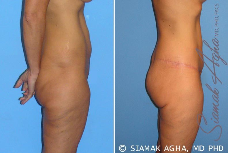 Lower Body Lift Before & After