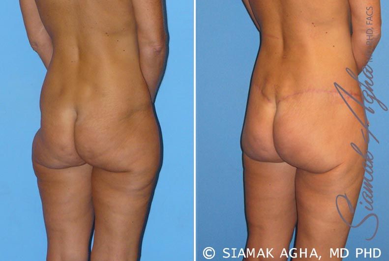 Lower Body Lift Before & After