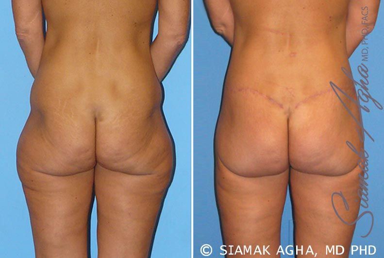 Lower Body Lift Before & After