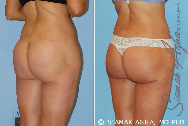 Lower Body Lift Before & After