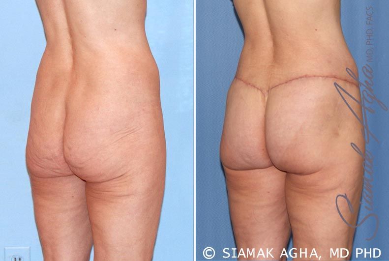 Lower Body Lift Before & After