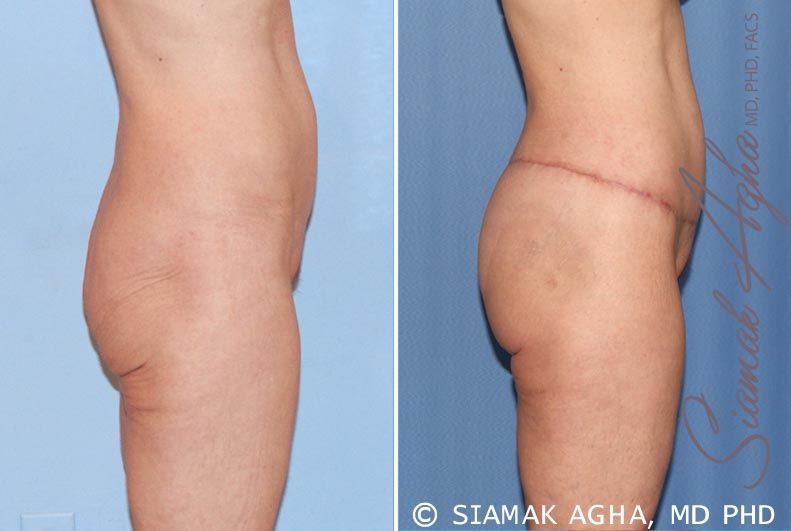 Lower Body Lift Before & After