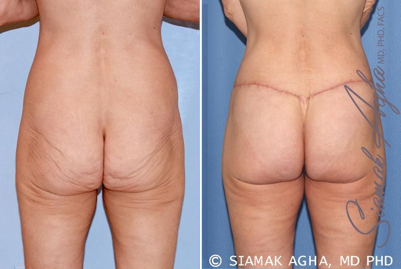 Lower Body Lift Before & After