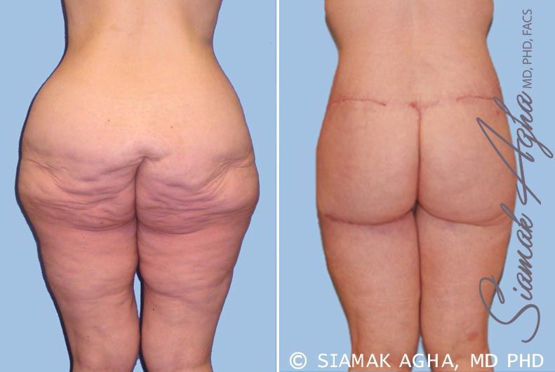 Lower Body Lift Before & After