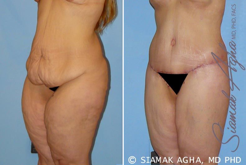 Lower Body Lift Before & After