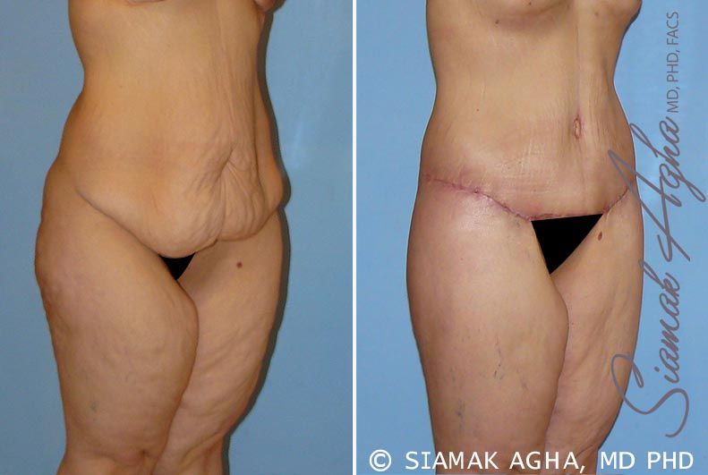 Lower Body Lift Before & After