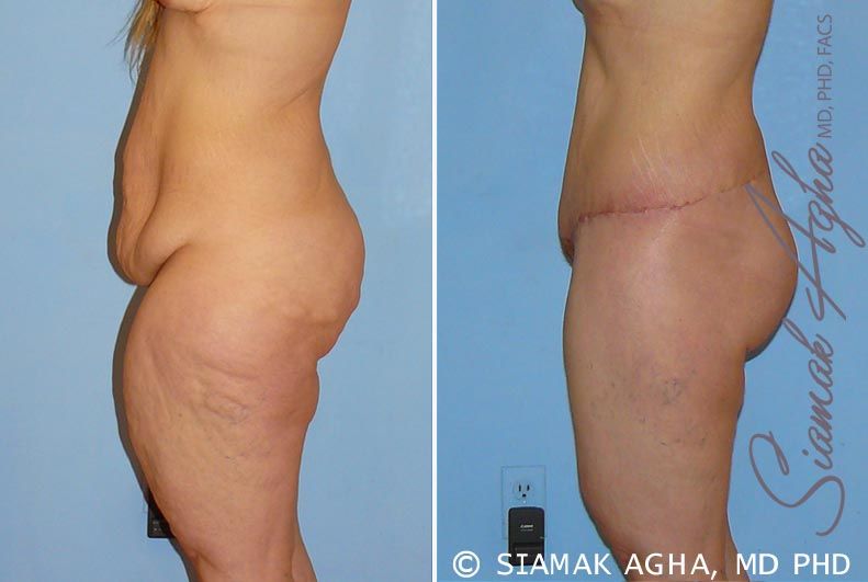 Lower Body Lift Before & After