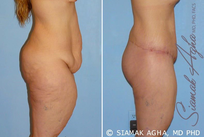 Lower Body Lift Before & After