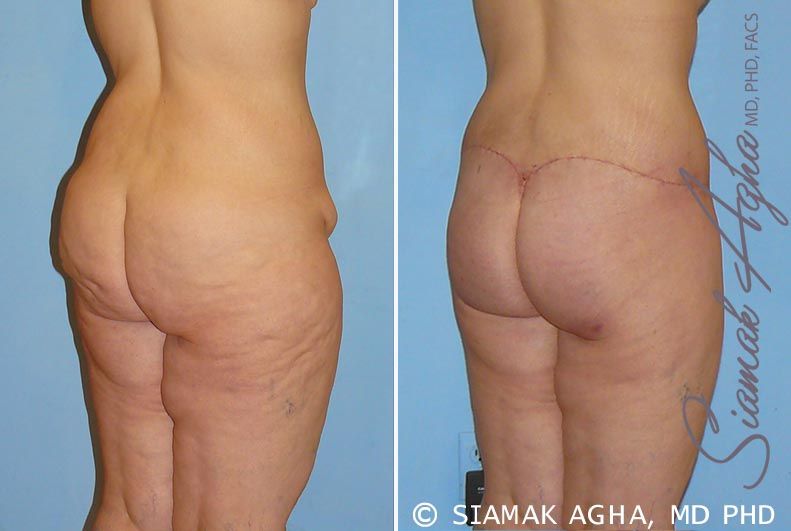 Lower Body Lift Before & After