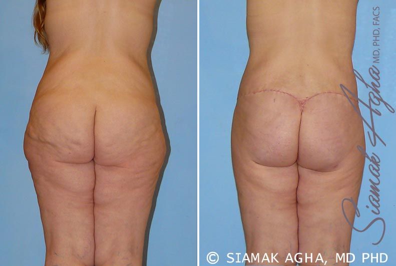 Lower Body Lift Before & After