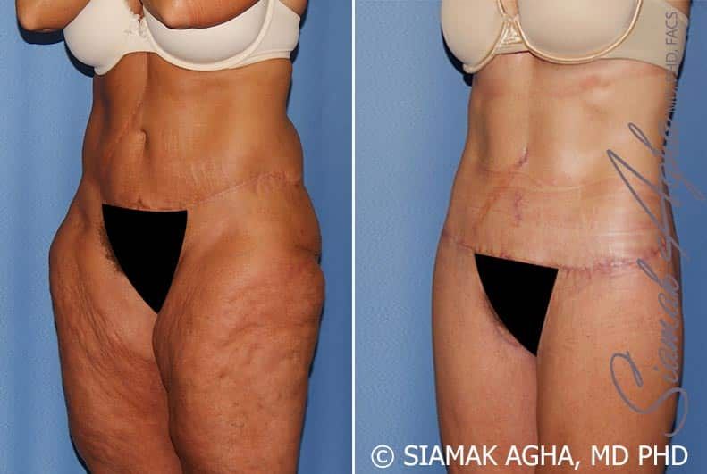 Lower Body Lift Before & After
