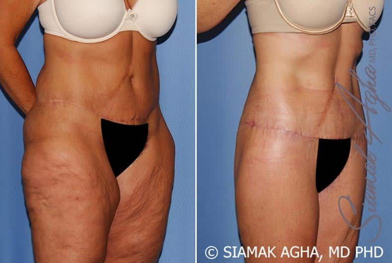 Lower Body Lift Before & After