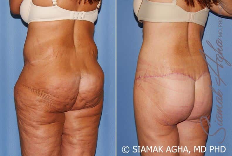 Lower Body Lift Before & After