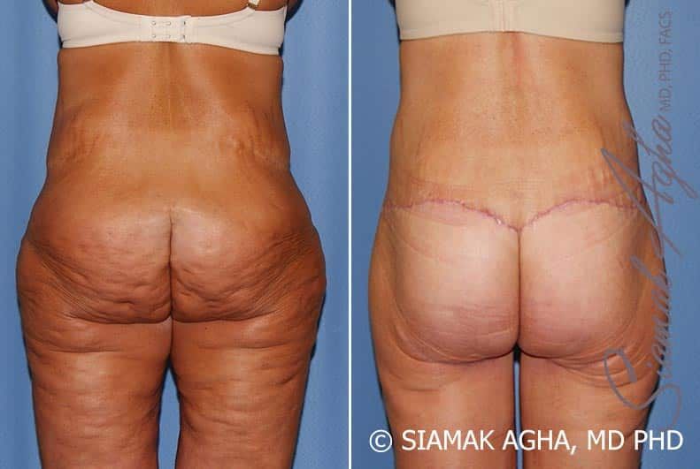 Lower Body Lift Before & After