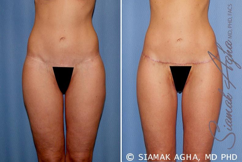 Lower Body Lift Before & After