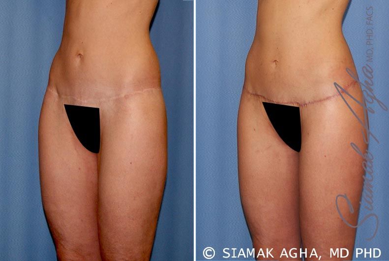 Lower Body Lift Before & After