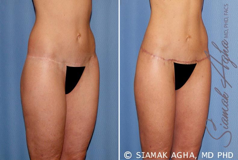 Lower Body Lift Before & After