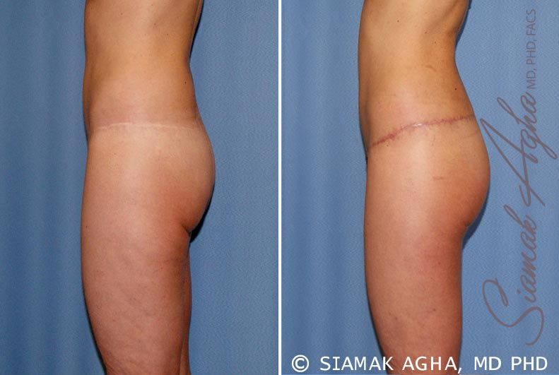 Lower Body Lift Before & After