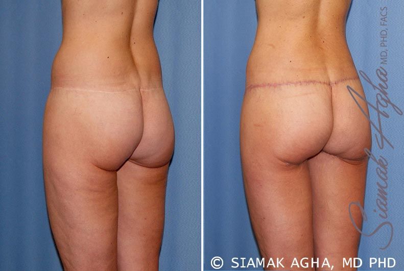 Lower Body Lift Before & After