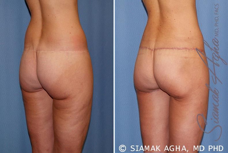 Lower Body Lift Before & After