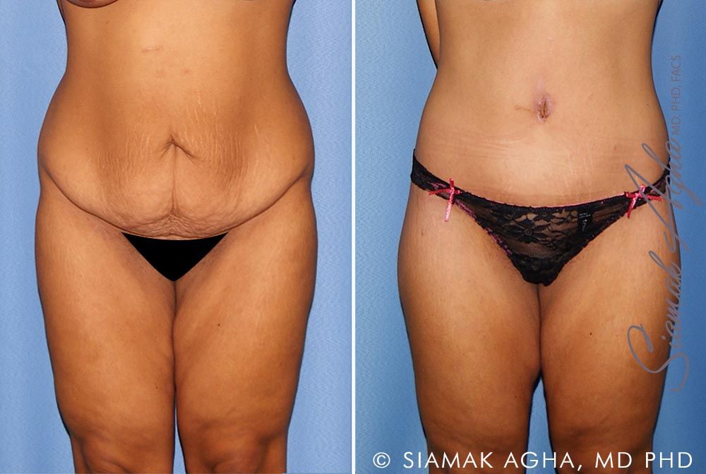 Lower Body Lift Before & After