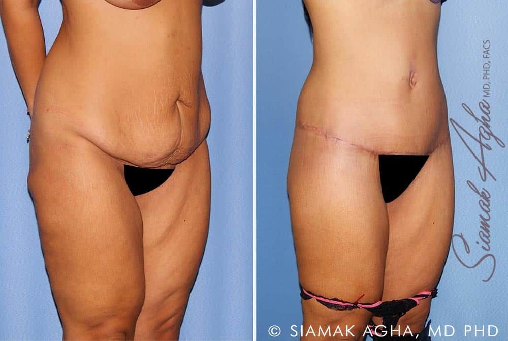 Lower Body Lift Before & After