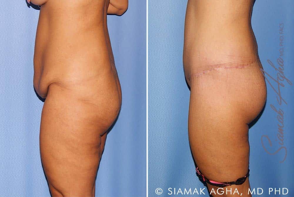 Lower Body Lift Before & After