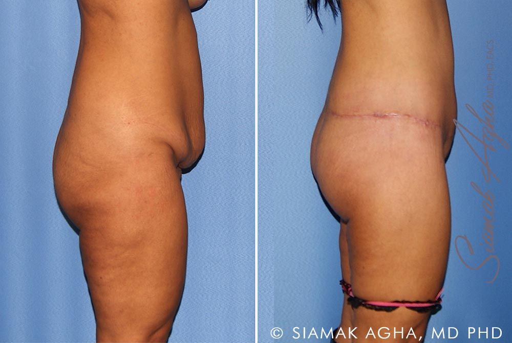 Lower Body Lift Before & After