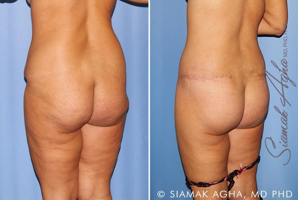 Lower Body Lift Before & After