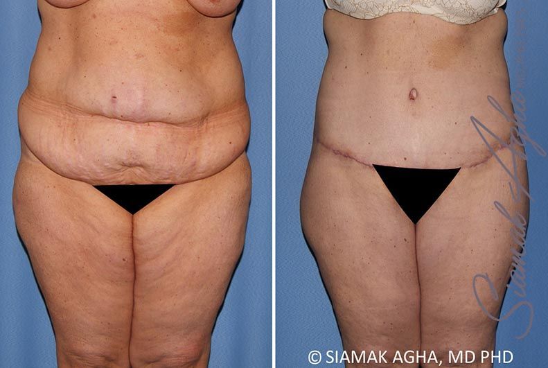 Lower Body Lift Before & After