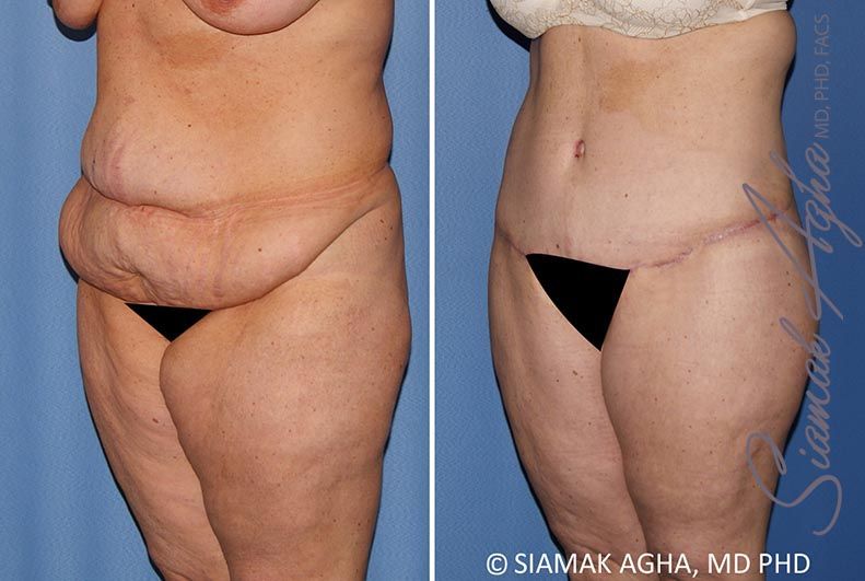 Lower Body Lift Before & After