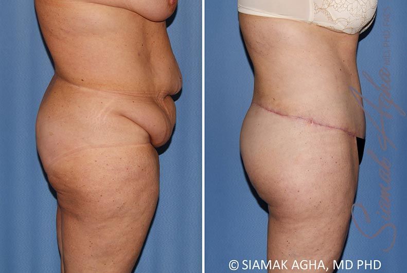 Lower Body Lift Before & After