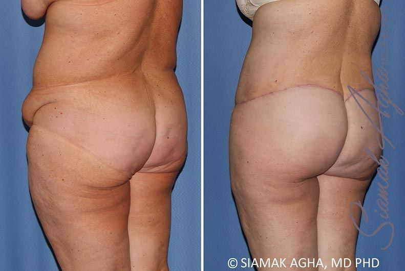 Lower Body Lift Before & After