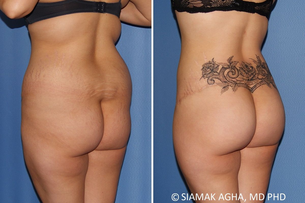 Lower Body Lift Before & After