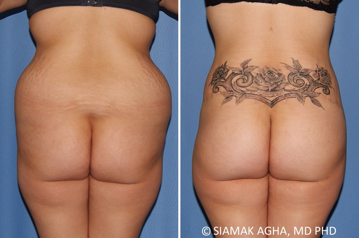 Lower Body Lift Before & After