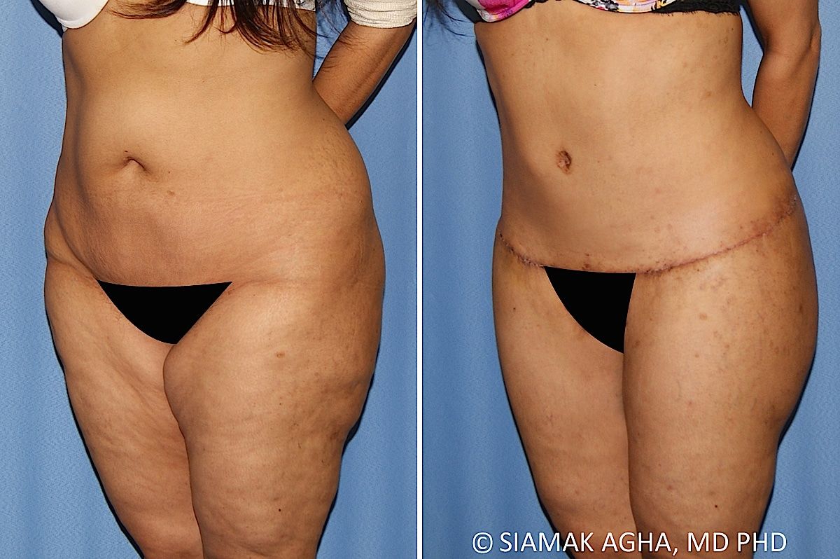 Lower Body Lift Before & After