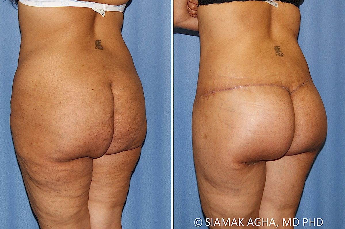 Lower Body Lift Before & After