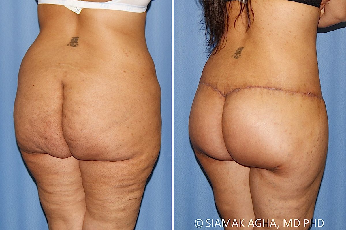 Lower Body Lift Before & After