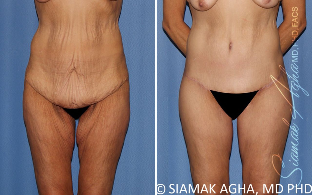 Lower Body Lift Before & After