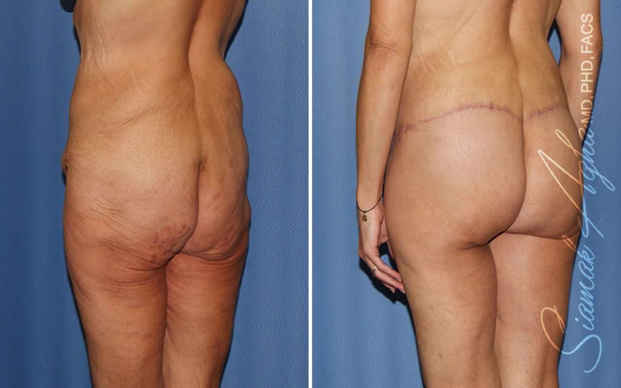 Lower Body Lift Before & After