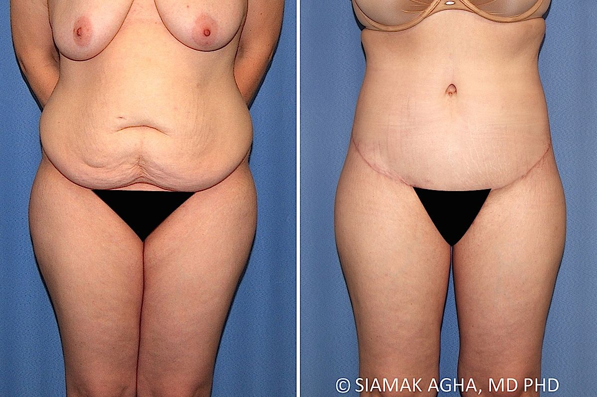 Lower Body Lift Before & After