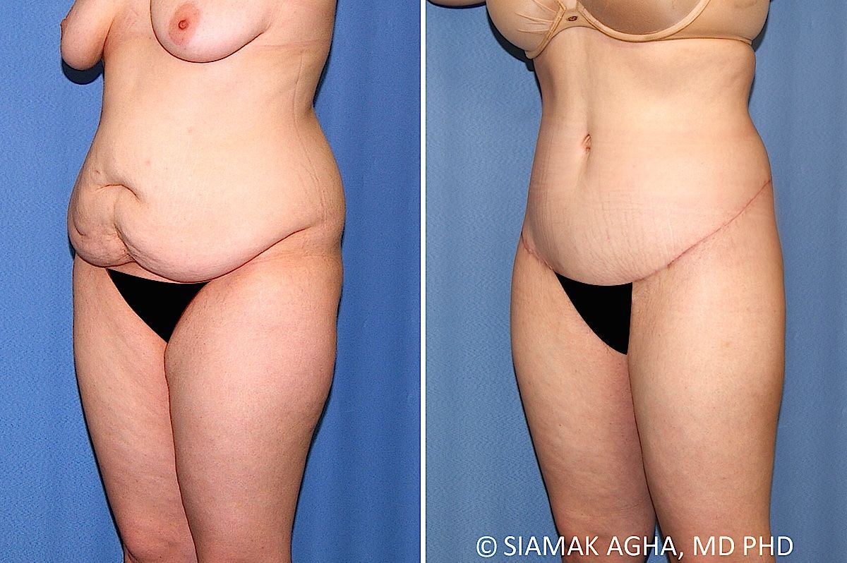 Lower Body Lift Before & After