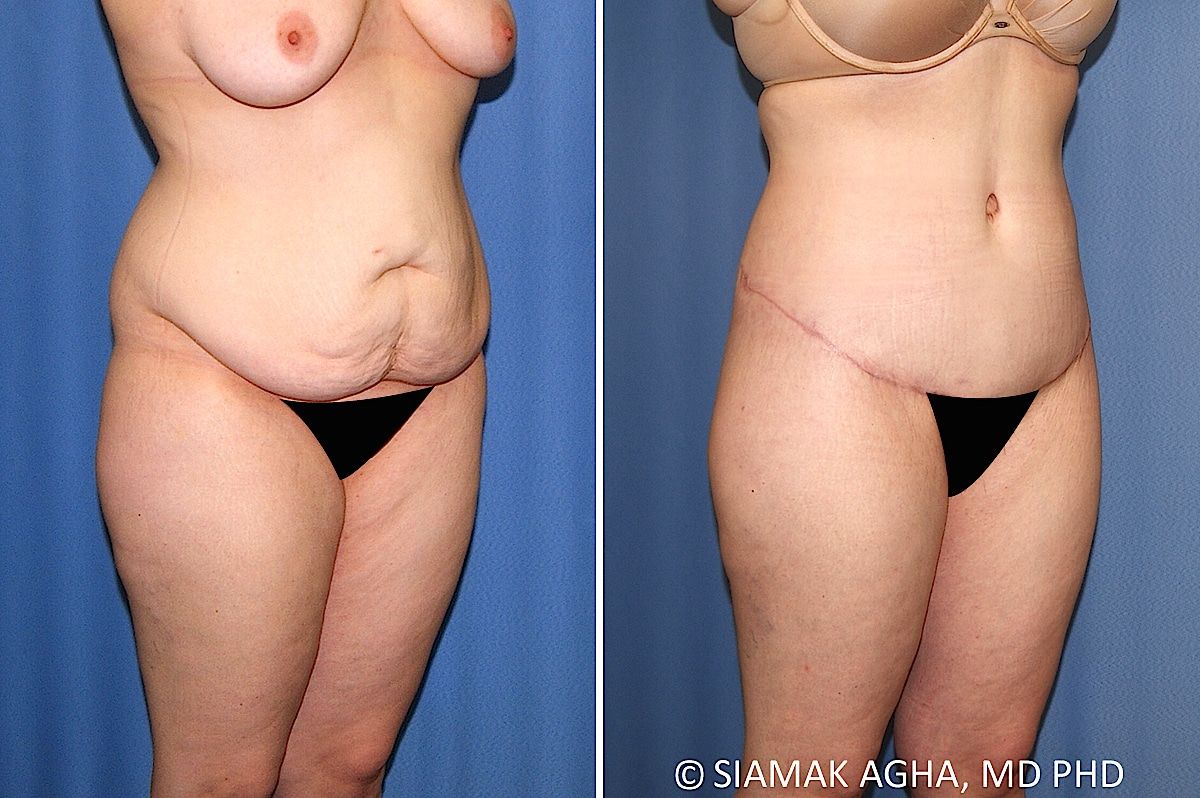 Lower Body Lift Before & After