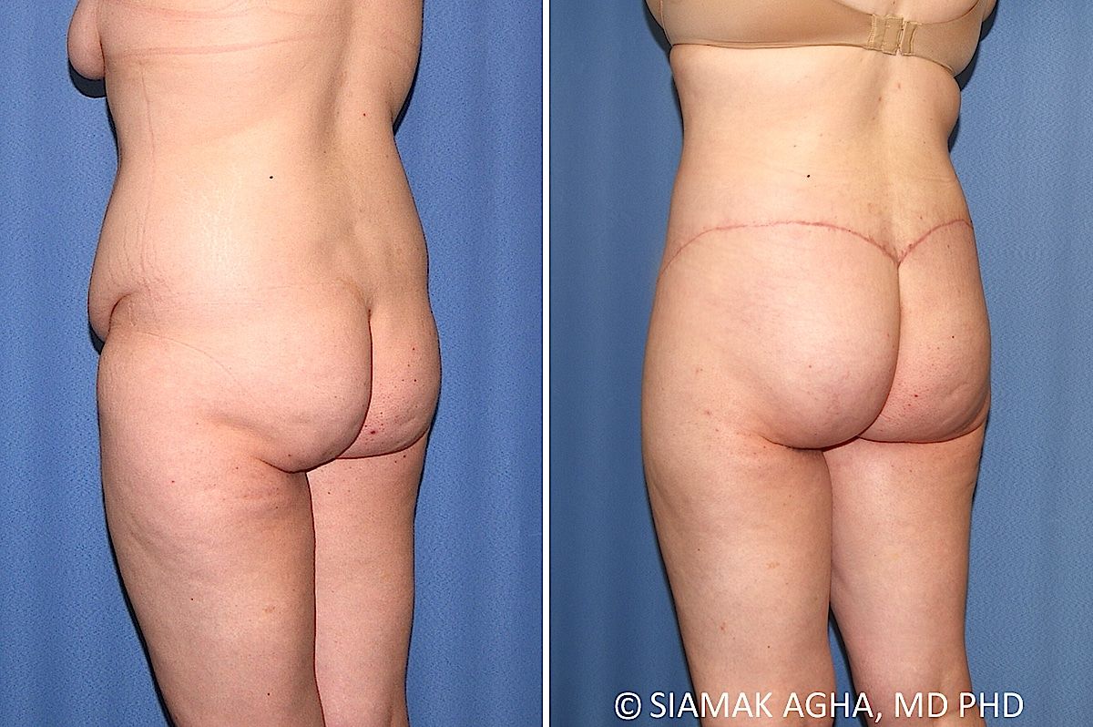 Lower Body Lift Before & After