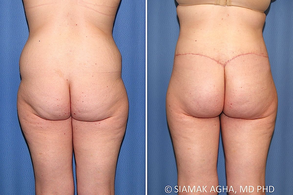 Lower Body Lift Before & After
