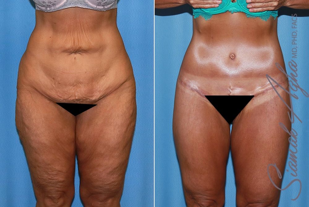 Lower Body Lift Before & After