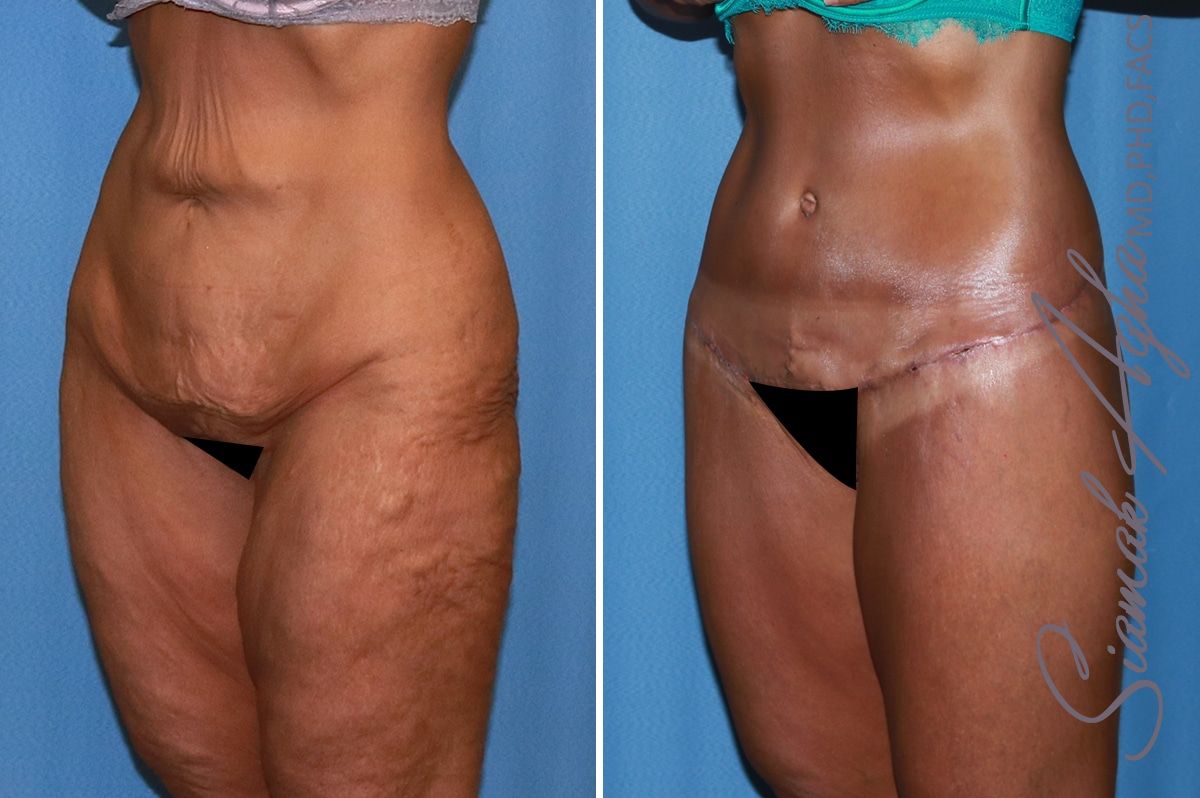 Lower Body Lift Before & After