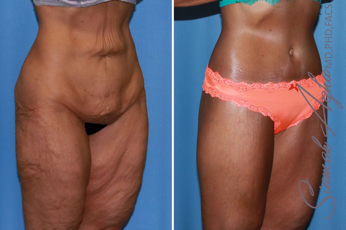 Lower Body Lift Before & After